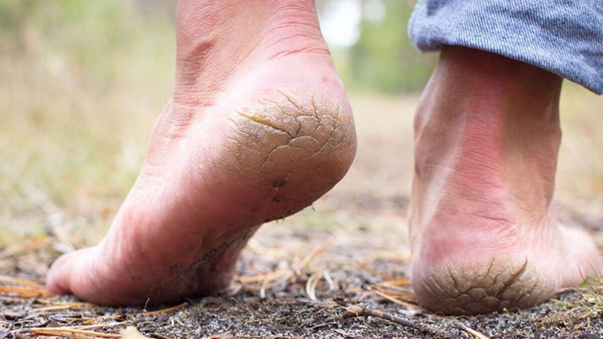 Home remedies for cracked heels
